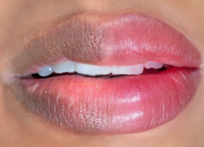 Lip Neutralization in Guwahati